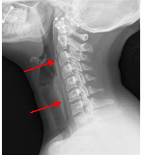 testing soft tissue of the neck|soft tissue neck.